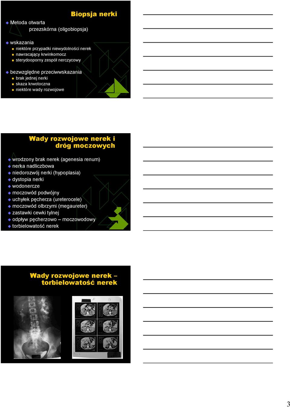 brak nerek (agenesia renum) nerka nadliczbowa niedorozwój nerki (hypoplasia) dystopia nerki wodonercze moczowód podwójny uchyłek pęcherza