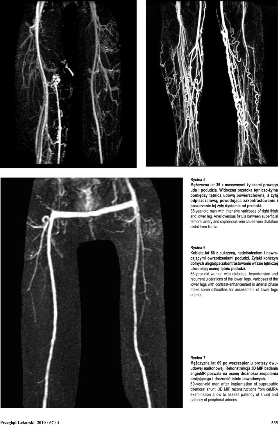 35-year-old man with intensive varicoses of right thigh and lower leg. Arteriovenous fistula between superficial femoral artery and saphenous vein cause vein dilatation distal from fistula.