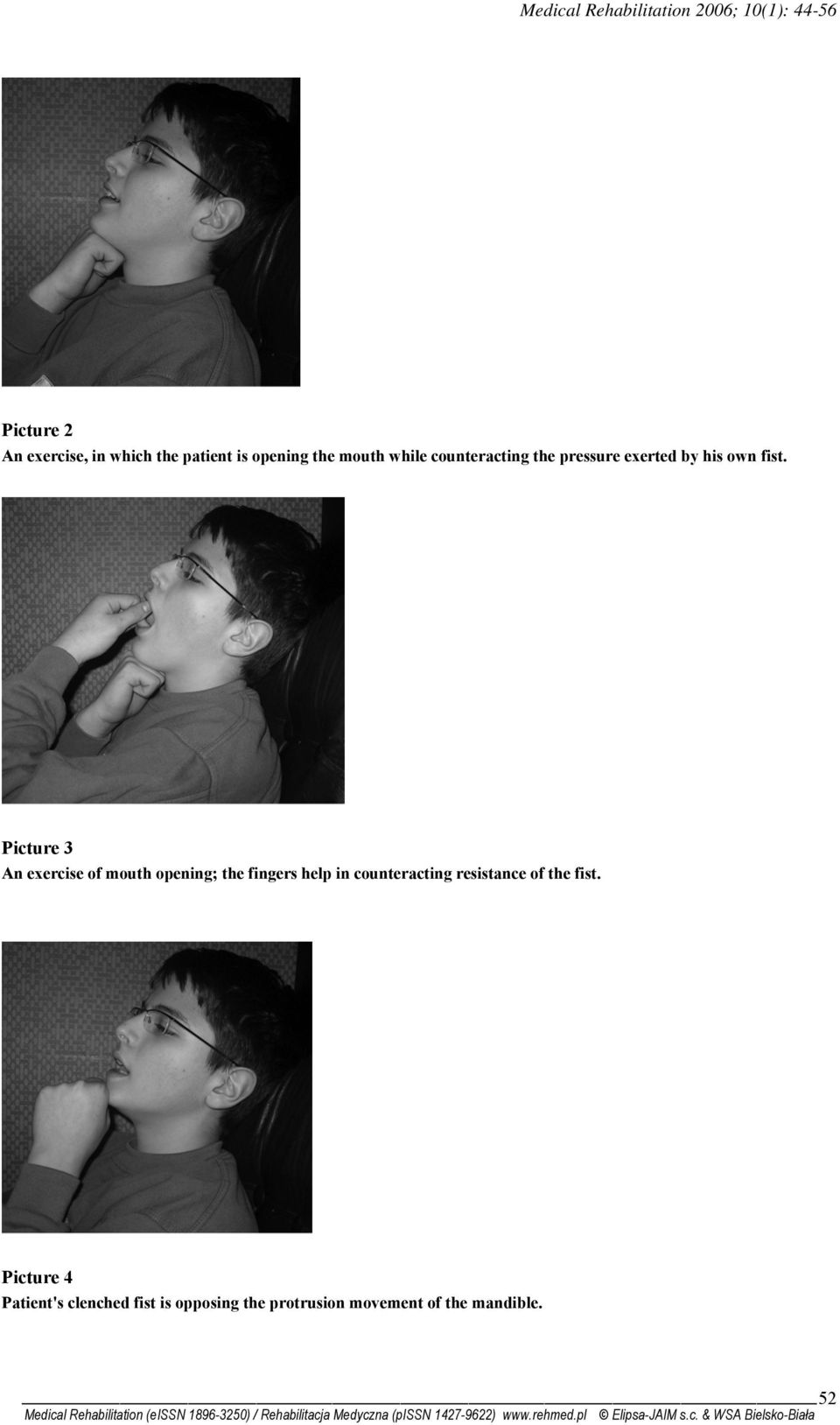 Picture 3 An exercise of mouth opening; the fingers help in counteracting