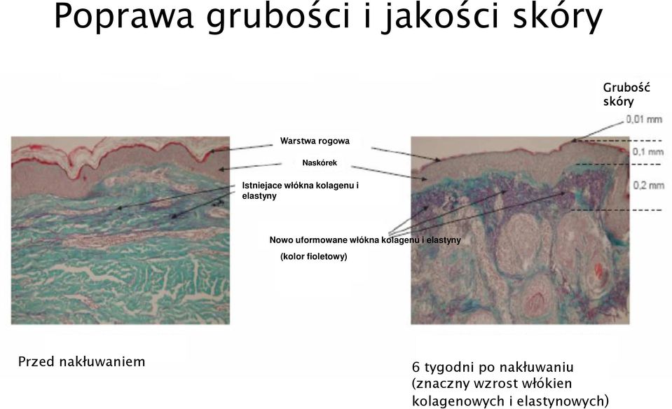 uformowane włókna kolagenu i elastyny (kolor fioletowy) rfioletowy) Przed