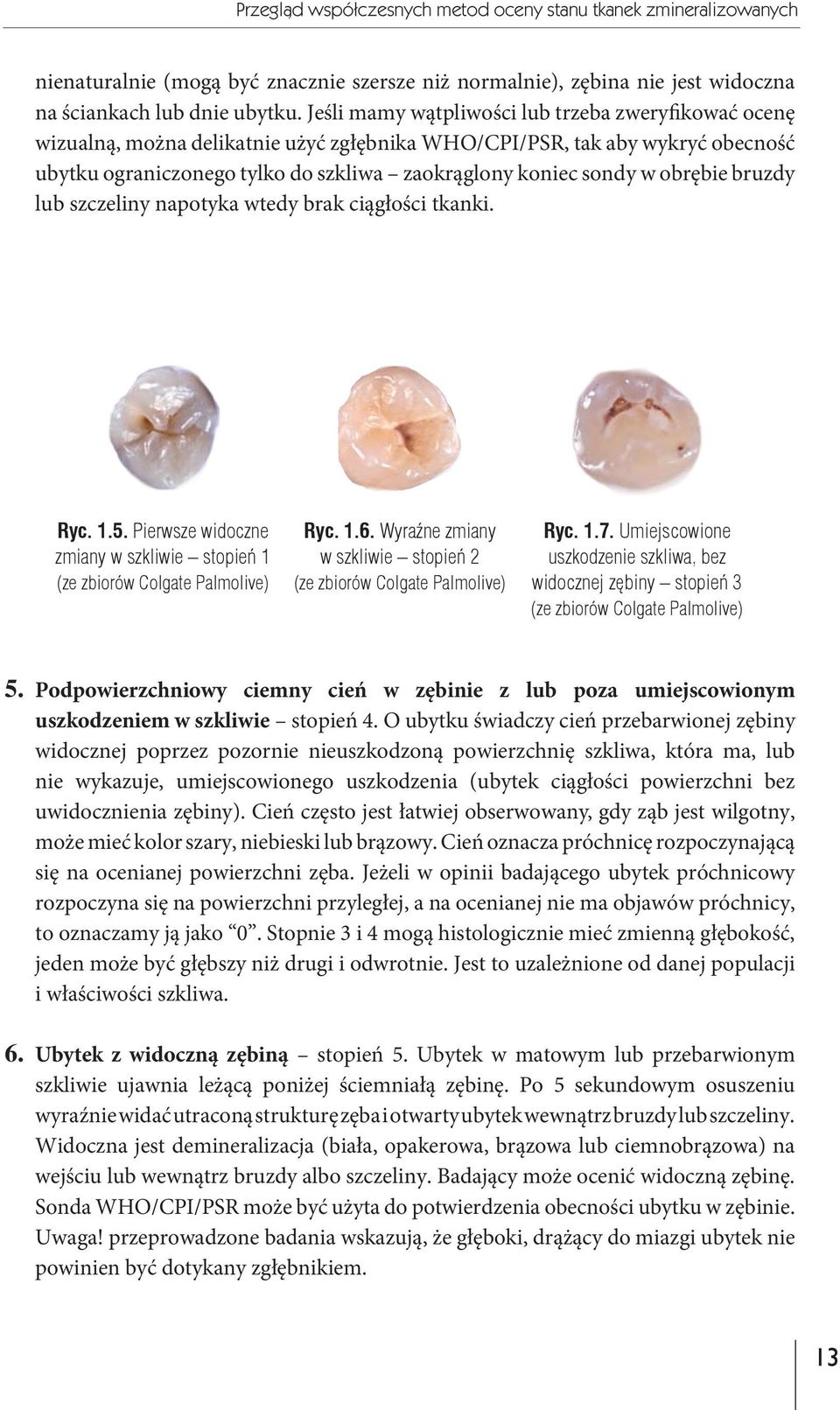 obrębie bruzdy lub szczeliny napotyka wtedy brak ciągłości tkanki. Ryc. 1.5. Pierwsze widoczne zmiany w szkliwie stopień 1 (ze zbiorów Colgate Palmolive) Ryc. 1.6.
