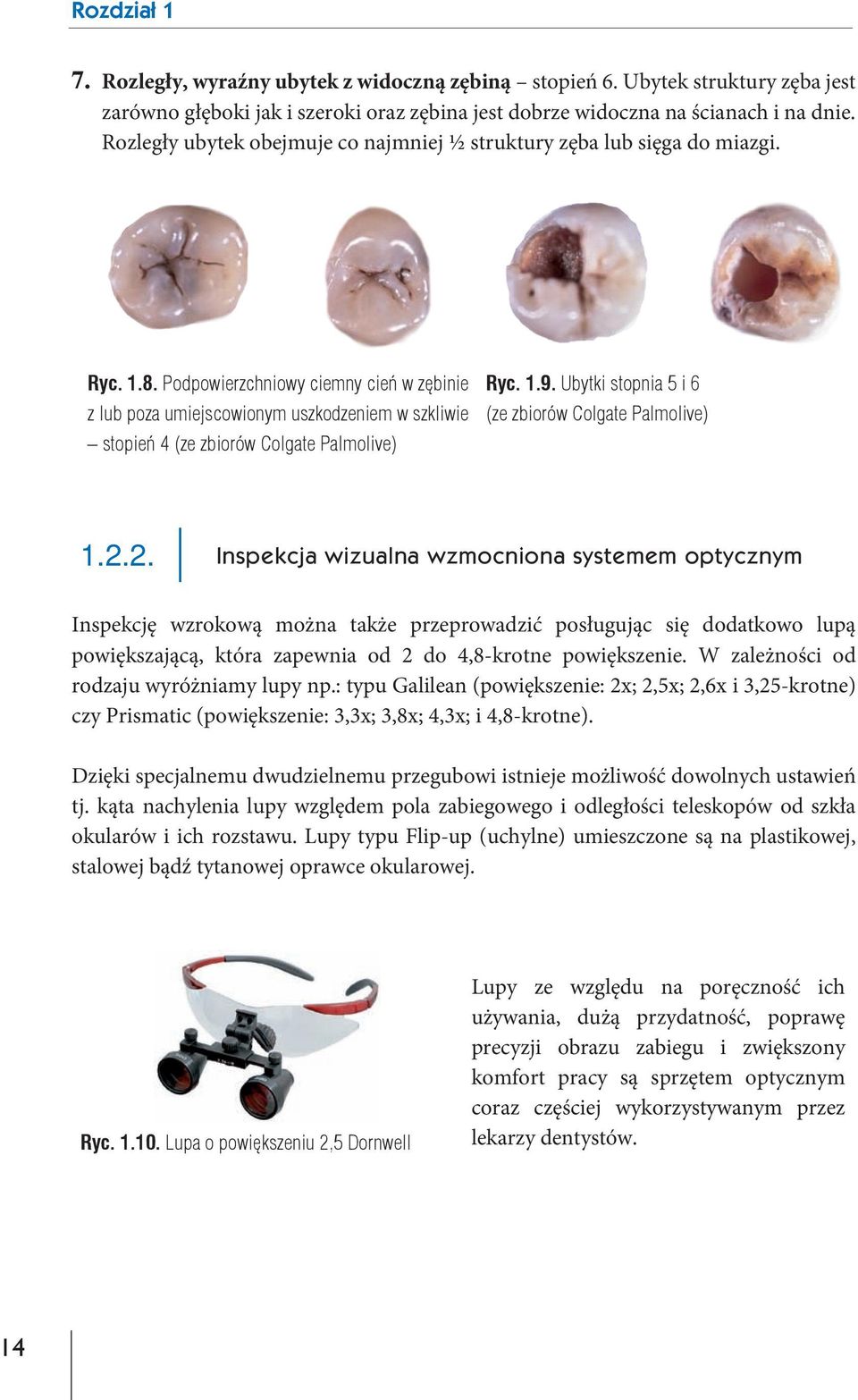 Ubytki stopnia 5 i 6 z lub poza umiejscowionym uszkodzeniem w szkliwie (ze zbiorów Colgate Palmolive) stopień 4 (ze zbiorów Colgate Palmolive) 1.2.