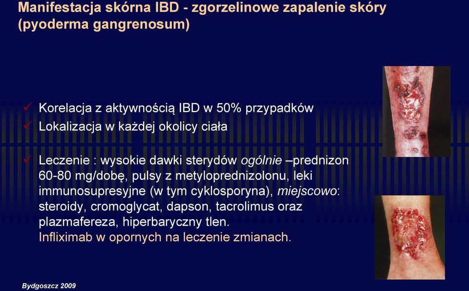 mg/dobę, pulsy z metyloprednizolonu, leki immunosupresyjne (w tym cyklosporyna), miejscowo: steroidy,