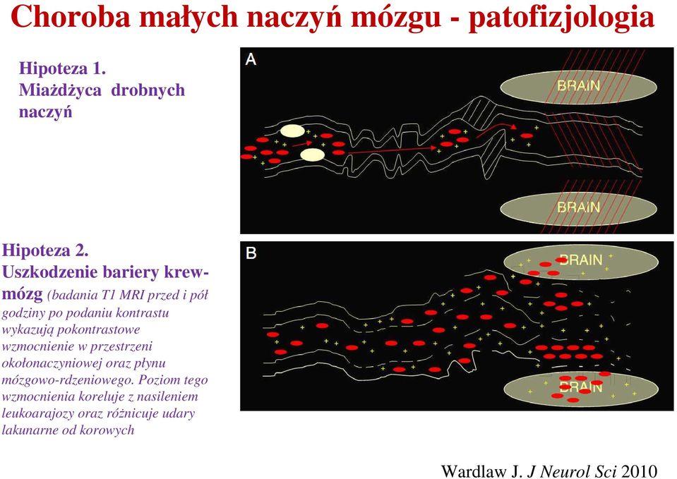pokontrastowe wzmocnienie w przestrzeni okołonaczyniowej oraz płynu mózgowo-rdzeniowego.
