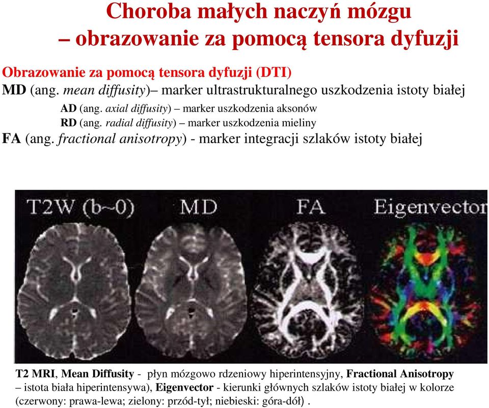radial diffusity) marker uszkodzenia mieliny FA (ang.