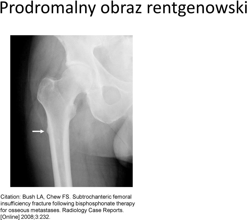 Subtrochanteric femoral insufficiency fracture