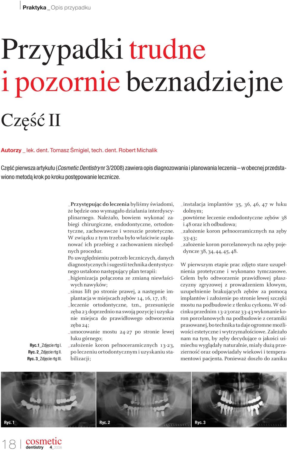 Robert Michalik Cz Êç pierwsza artyku u (Cosmetic Dentistry nr 3/2008) zawiera opis diagnozowania i planowania leczenia w obecnej przedstawiono metodà krok po kroku post powanie lecznicze. Ryc.