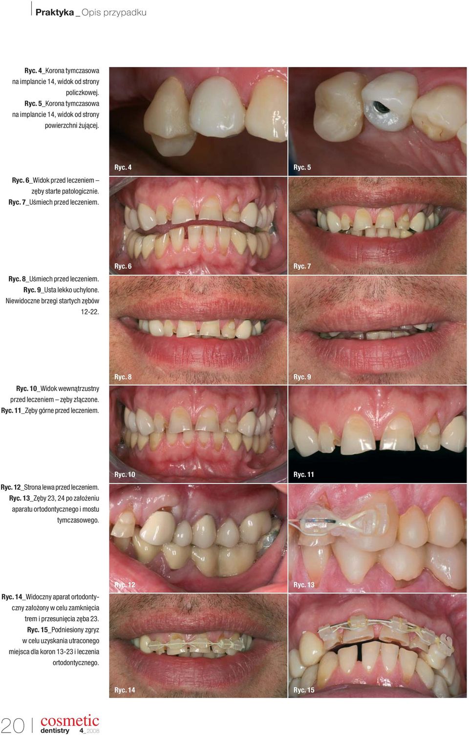 Ryc. 10_Widok wewnàtrzustny przed leczeniem z by z àczone. Ryc. 11_Z by górne przed leczeniem. Ryc. 8 Ryc. 9 Ryc. 10 Ryc. 11 Ryc. 12_Strona lewa przed leczeniem. Ryc. 13_Z by 23, 24 po za o eniu aparatu ortodontycznego i mostu tymczasowego.