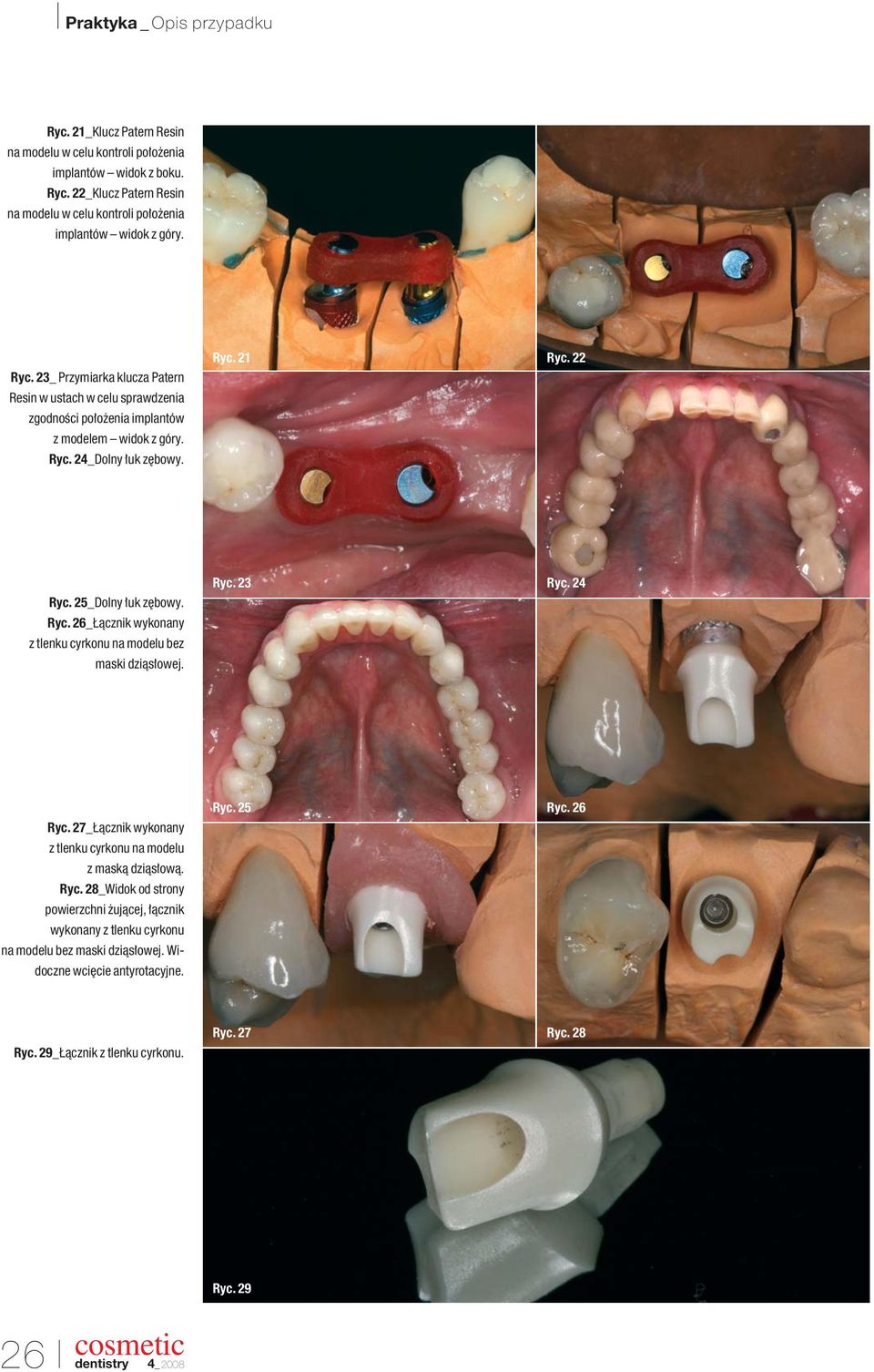 23_ Przymiarka klucza Patern Resin w ustach w celu sprawdzenia zgodnoêci po o enia implantów z modelem widok z góry. Ryc. 24_Dolny uk z bowy. Ryc. 21 Ryc. 22 Ryc. 25_Dolny uk z bowy.