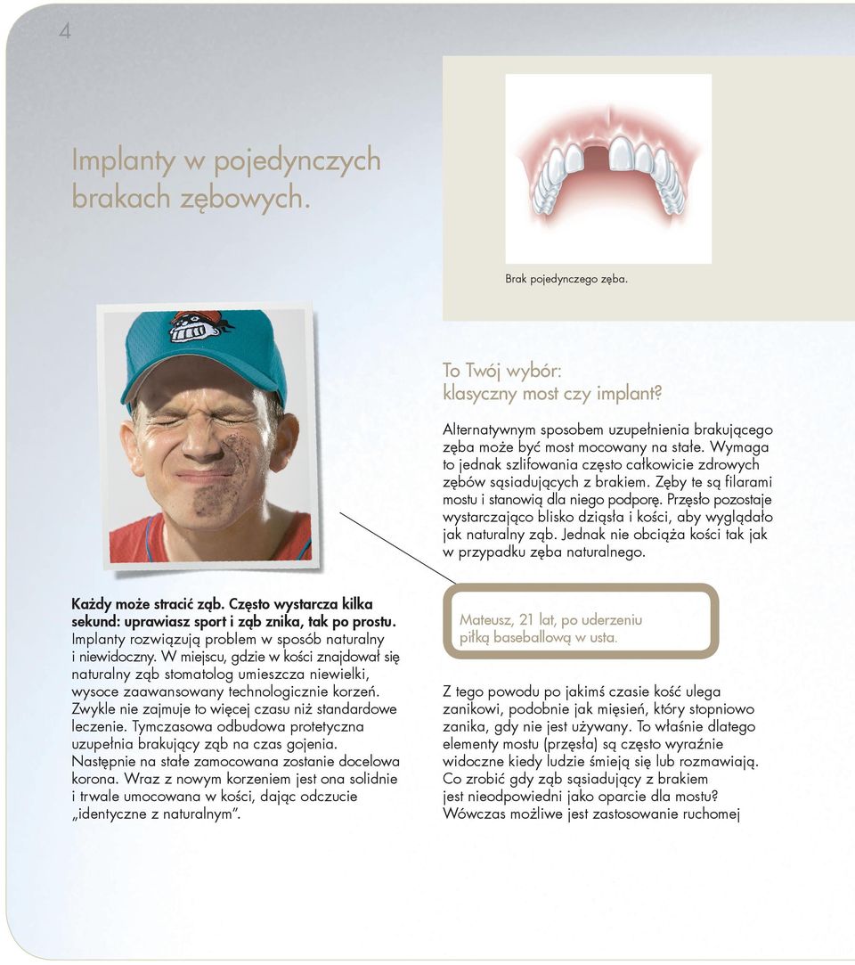 Przęsło pozostaje wystarczająco blisko dziąsła i kości, aby wyglądało jak naturalny ząb. Jednak nie obciąża kości tak jak w przypadku zęba naturalnego. Każdy może stracić ząb.