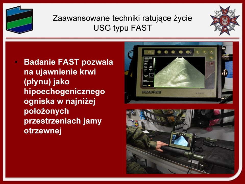 (płynu) jako hipoechogenicznego ogniska w