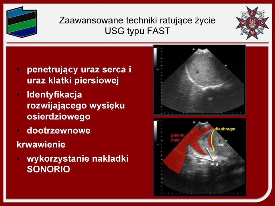 Identyfikacja rozwijającego wysięku osierdziowego