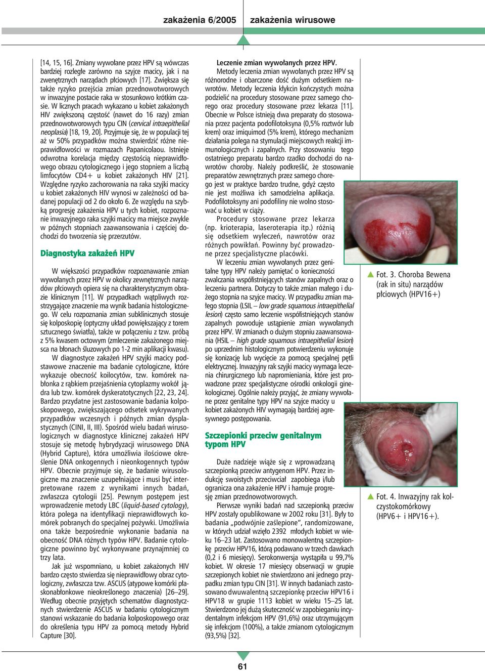 W licznych pracach wykazano u kobiet zakażonych HIV zwiększoną częstość (nawet do 16 razy) zmian przednowotworowych typu CIN (cervical intraepithelial neoplasia) [18, 19, 20].