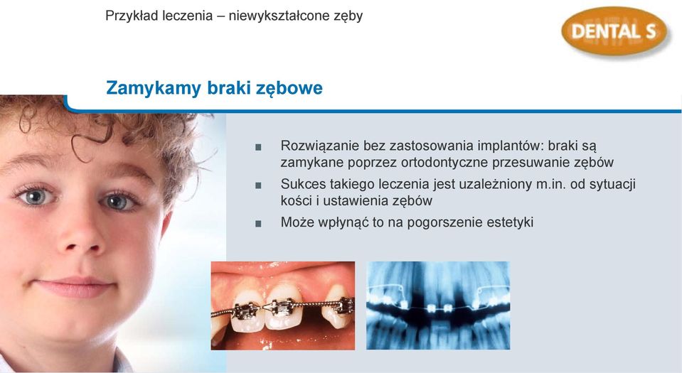 ortodontyczne przesuwanie zębów Sukces takiego leczenia jest