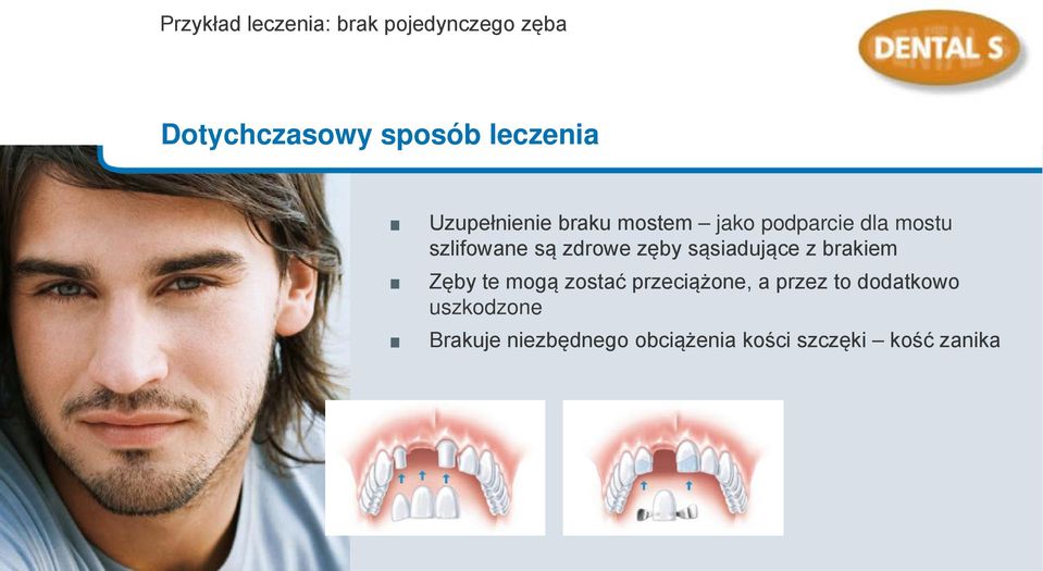 zęby sąsiadujące z brakiem Zęby te mogą zostać przeciążone, a przez to