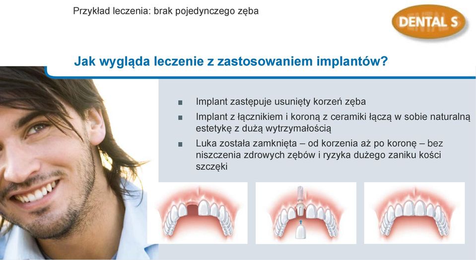 Implant zastępuje usunięty korzeń zęba Implant z łącznikiem i koroną z ceramiki