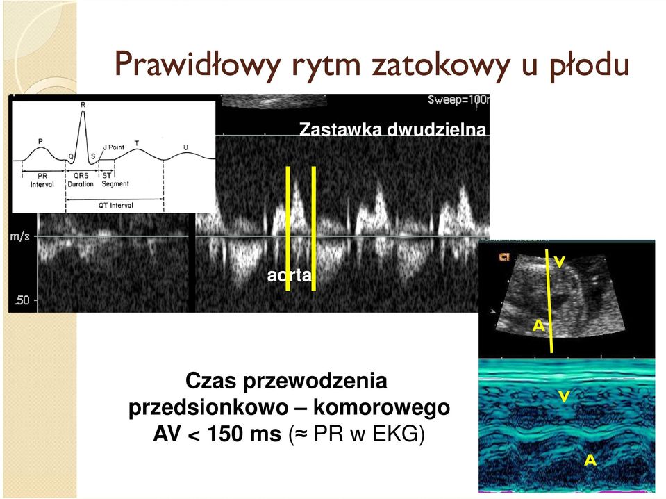 Czas przewodzenia przedsionkowo