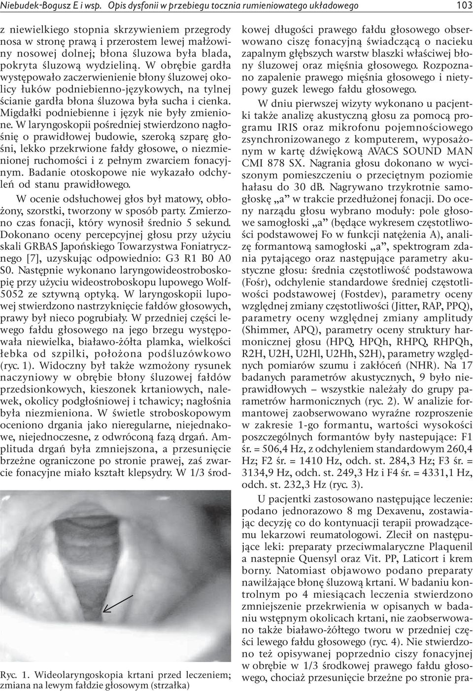 Wideolaryngoskopia krtani przed leczeniem; zmiana na lewym fałdzie głosowym (strzałka) z niewielkiego stopnia skrzywieniem przegrody nosa w stronę prawą i przerostem lewej małżowiny nosowej dolnej;