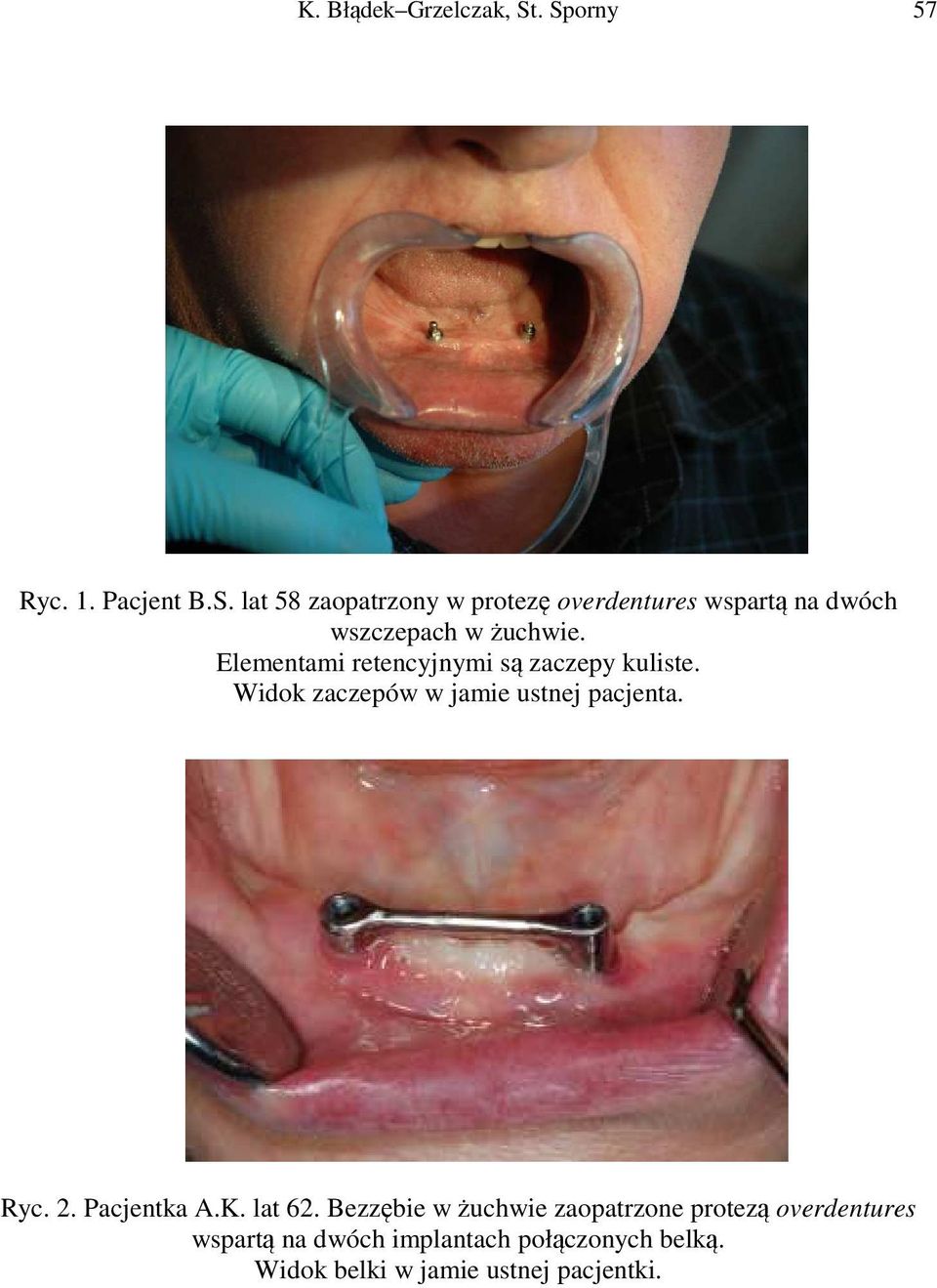 Elementami retencyjnymi są zaczepy kuliste. Widok zaczepów w jamie ustnej pacjenta. Ryc. 2.
