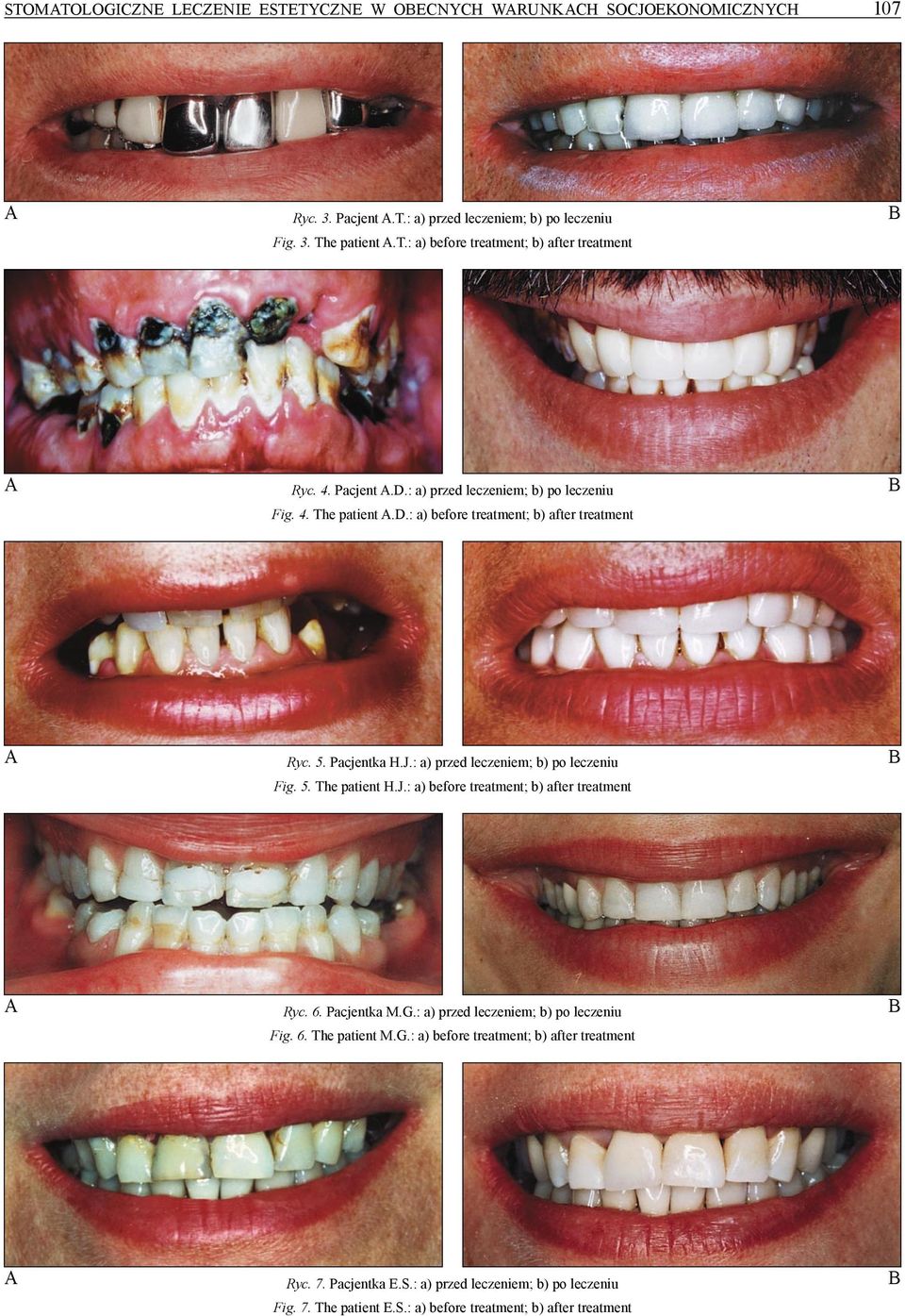 : a) przed leczeniem; b) po leczeniu Fig. 5. The patient H.J.: a) before treatment; b) after treatment B A Ryc. 6. Pacjentka M.G.: a) przed leczeniem; b) po leczeniu Fig. 6. The patient M.