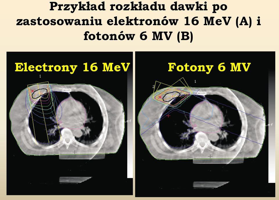 MeV (A) i fotonów 6 MV (B)