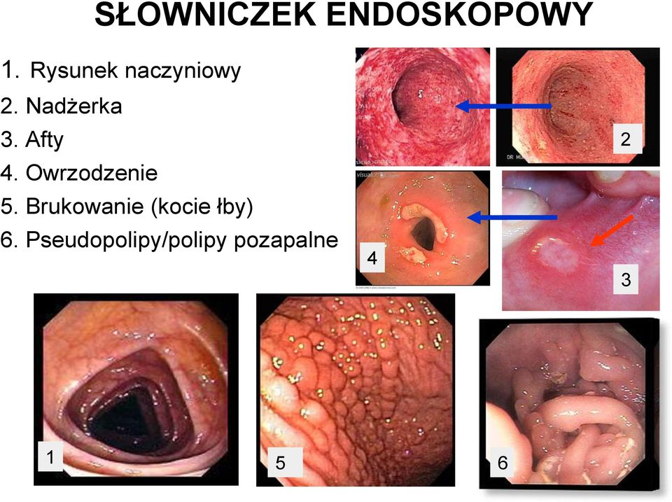 Afty 4. Owrzodzenie 5.