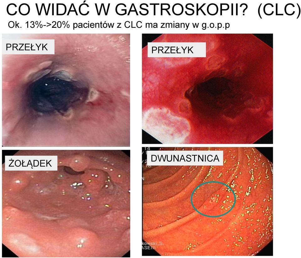 13%->20% pacientów z CLC ma