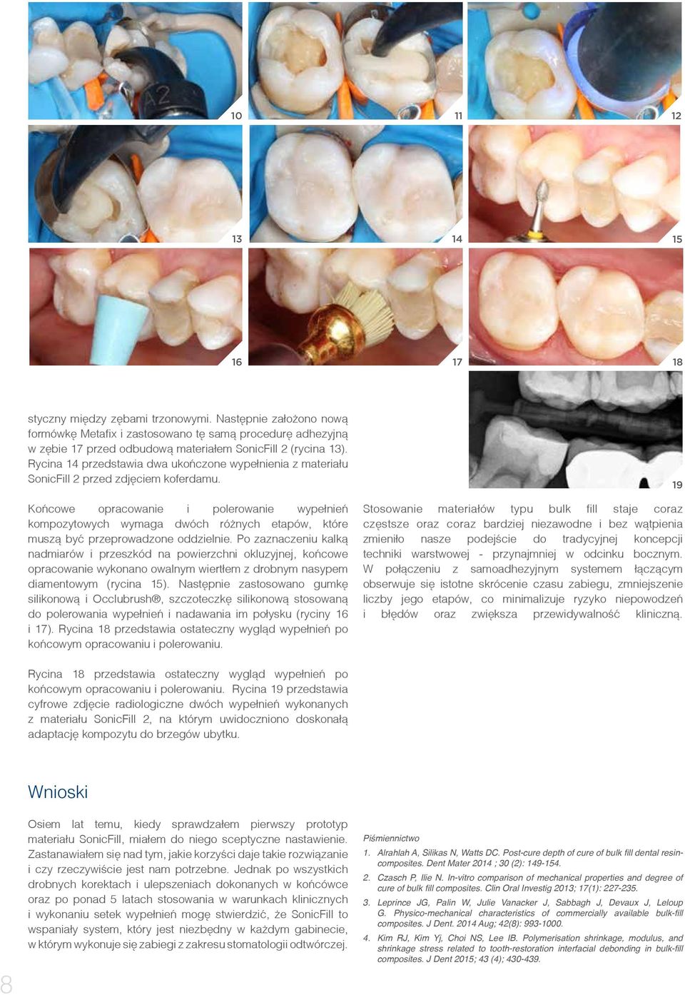 Rycina 14 przedstawia dwa ukończone wypełnienia z materiału SonicFill 2 przed zdjęciem koferdamu.