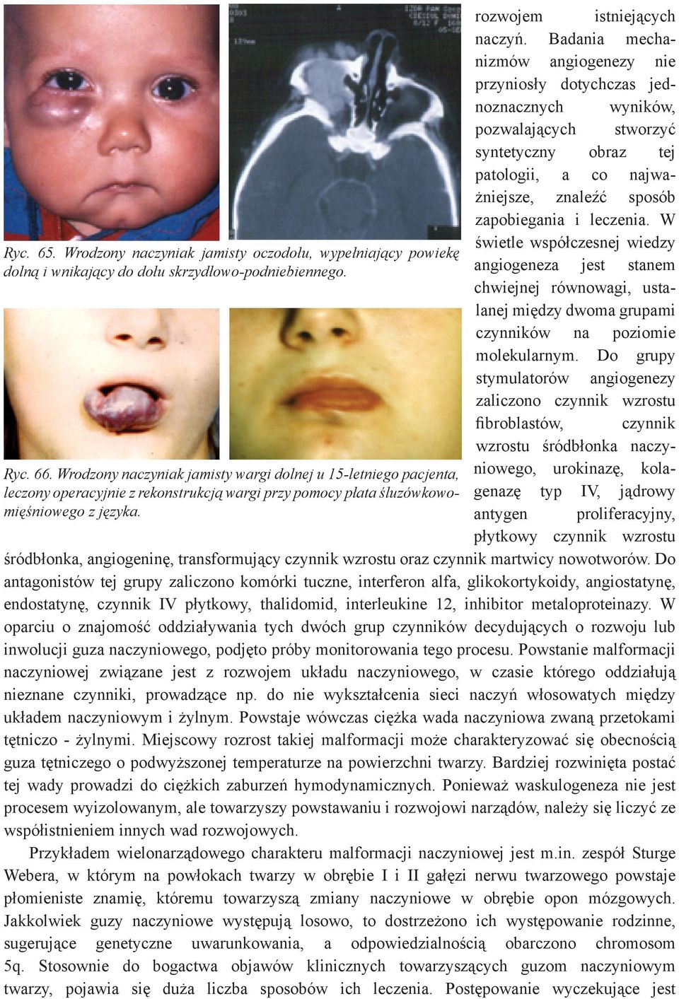 W świetle współczesnej wiedzy Ryc. 65. Wrodzony naczyniak jamisty oczodołu, wypełniający powiekę dolną i wnikający do dołu skrzydłowo-podniebiennego.