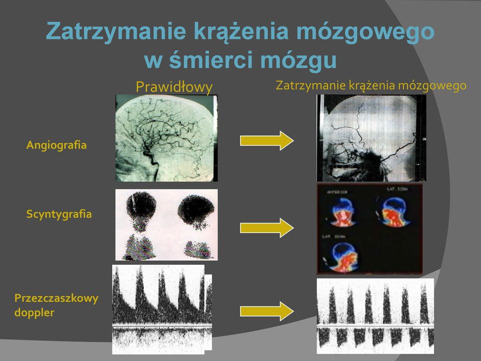 Zatrzymanie krążenia mózgowego