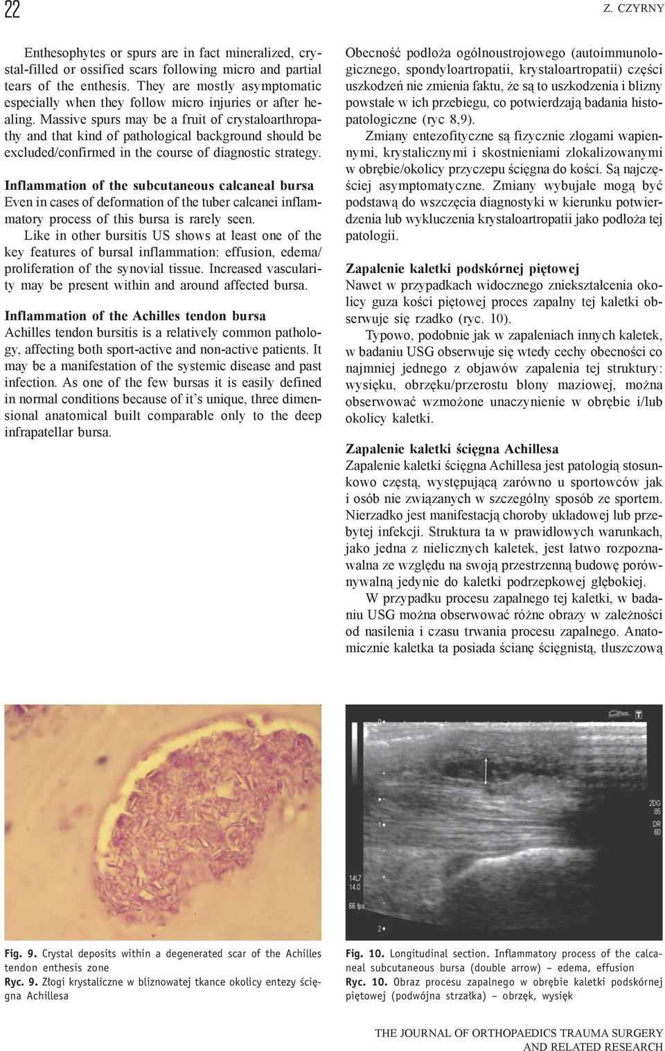 Massive spurs may be a fruit of crystaloarthropathy and that kind of pathological background should be excluded/confirmed in the course of diagnostic strategy.