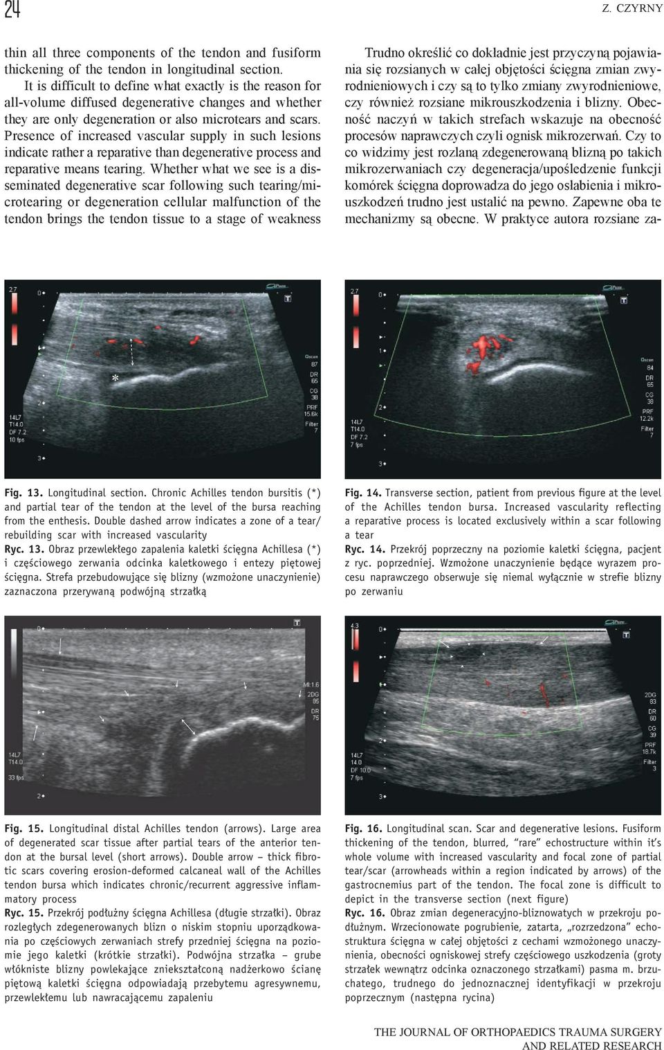 Presence of increased vascular supply in such lesions indicate rather a reparative than degenerative process and reparative means tearing.