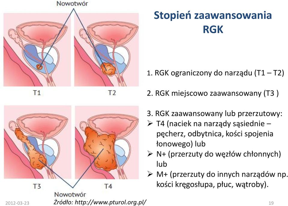 RGK zaawansowany lub przerzutowy: T4 (naciek na narządy sąsiednie pęcherz, odbytnica, kości