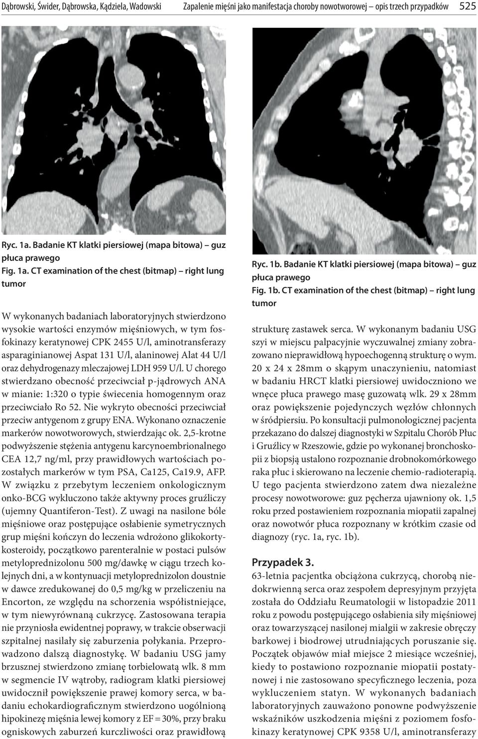 CT examination of the chest (bitmap) right lung tumor W wykonanych badaniach laboratoryjnych stwierdzono wysokie wartości enzymów mięśniowych, w tym fosfokinazy keratynowej CPK 2455 U/l,