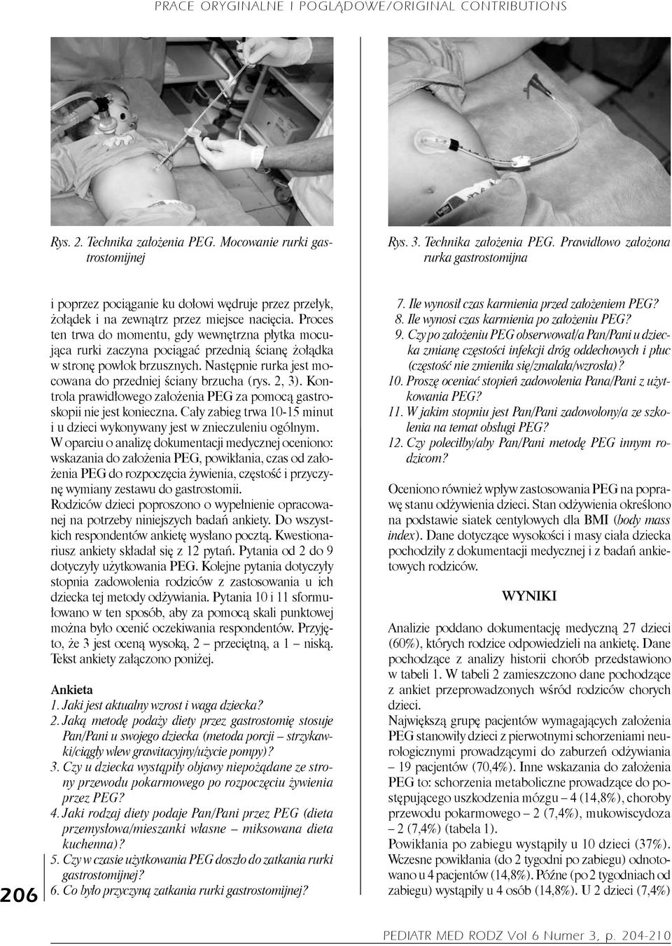 2, 3). Kontrola prawidłowego założenia PEG za pomocą gastroskopii nie jest konieczna. Cały zabieg trwa 1-15 minut i u dzieci wykonywany jest w znieczuleniu ogólnym.