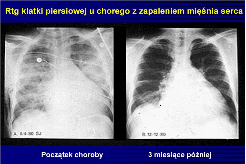 mięśnia serca Początek