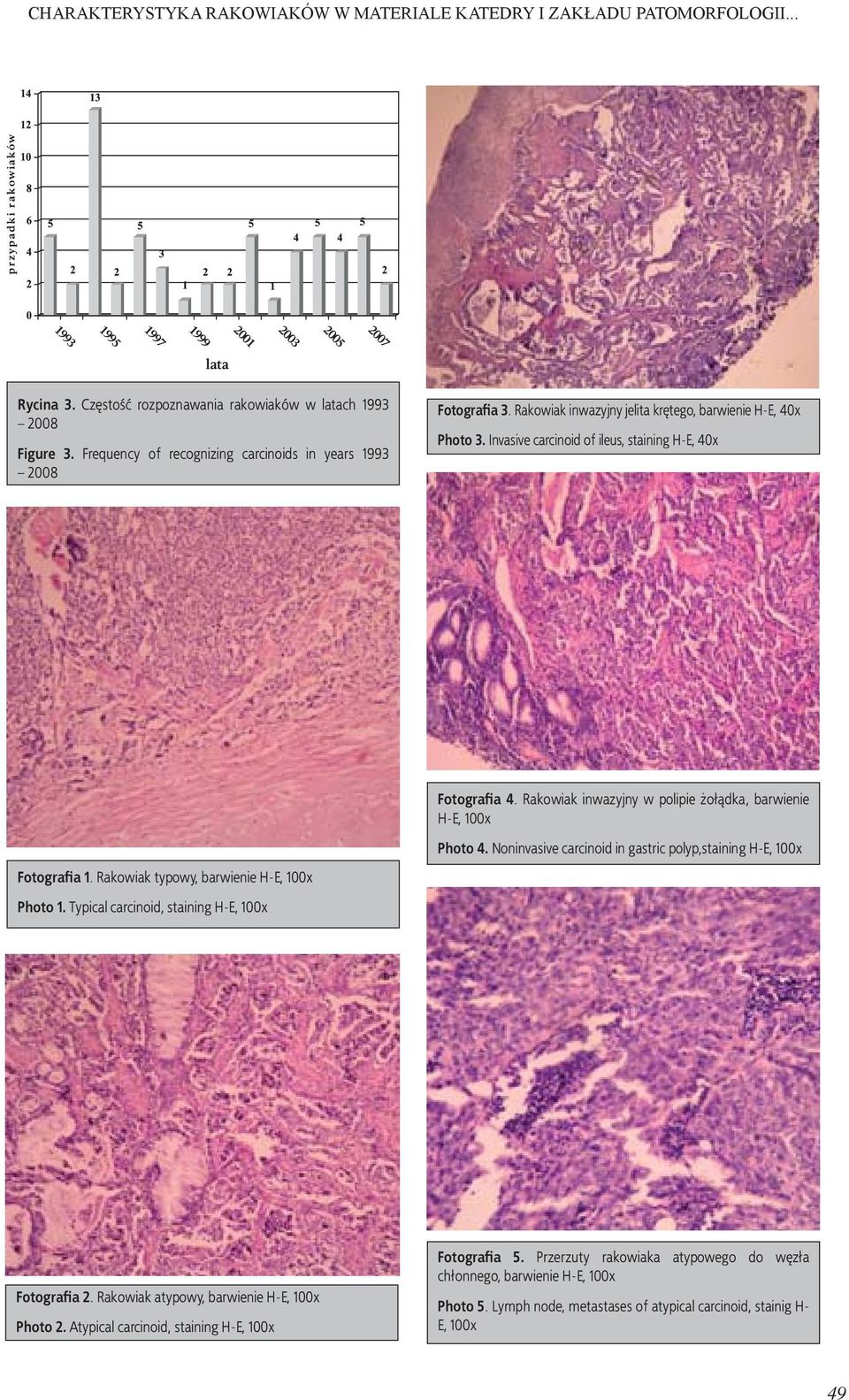 Rakowiak inwazyjny w polipie żołądka, barwienie H-E, 100x Photo 4. Noninvasive carcinoid in gastric polyp,staining H-E, 100x Fotografia 1. Rakowiak typowy, barwienie H-E, 100x Photo 1.