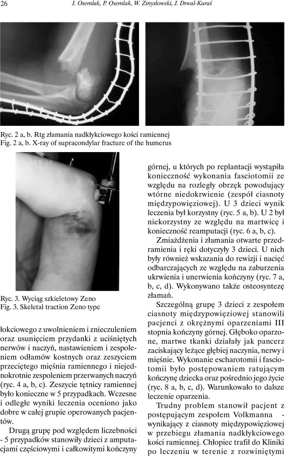 Skeletal traction Zeno type łokciowego z uwolnieniem i znieczuleniem oraz usunięciem przydanki z uciśniętych nerwów i naczyń, nastawieniem i zespoleniem odłamów kostnych oraz zeszyciem przeciętego