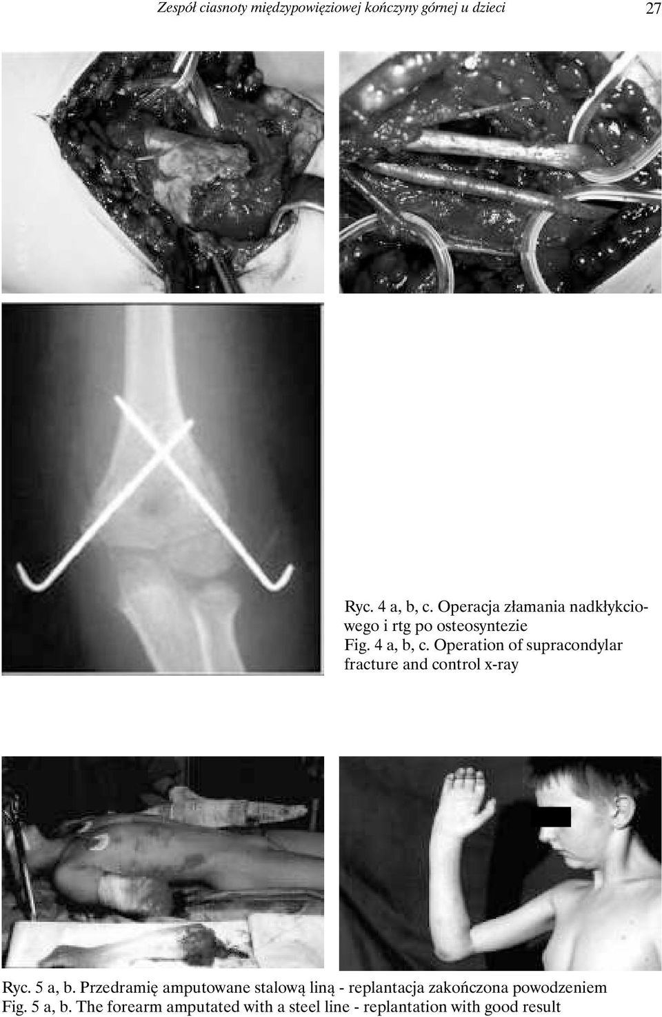 Operation of supracondylar fracture and control x-ray Ryc. 5 a, b.