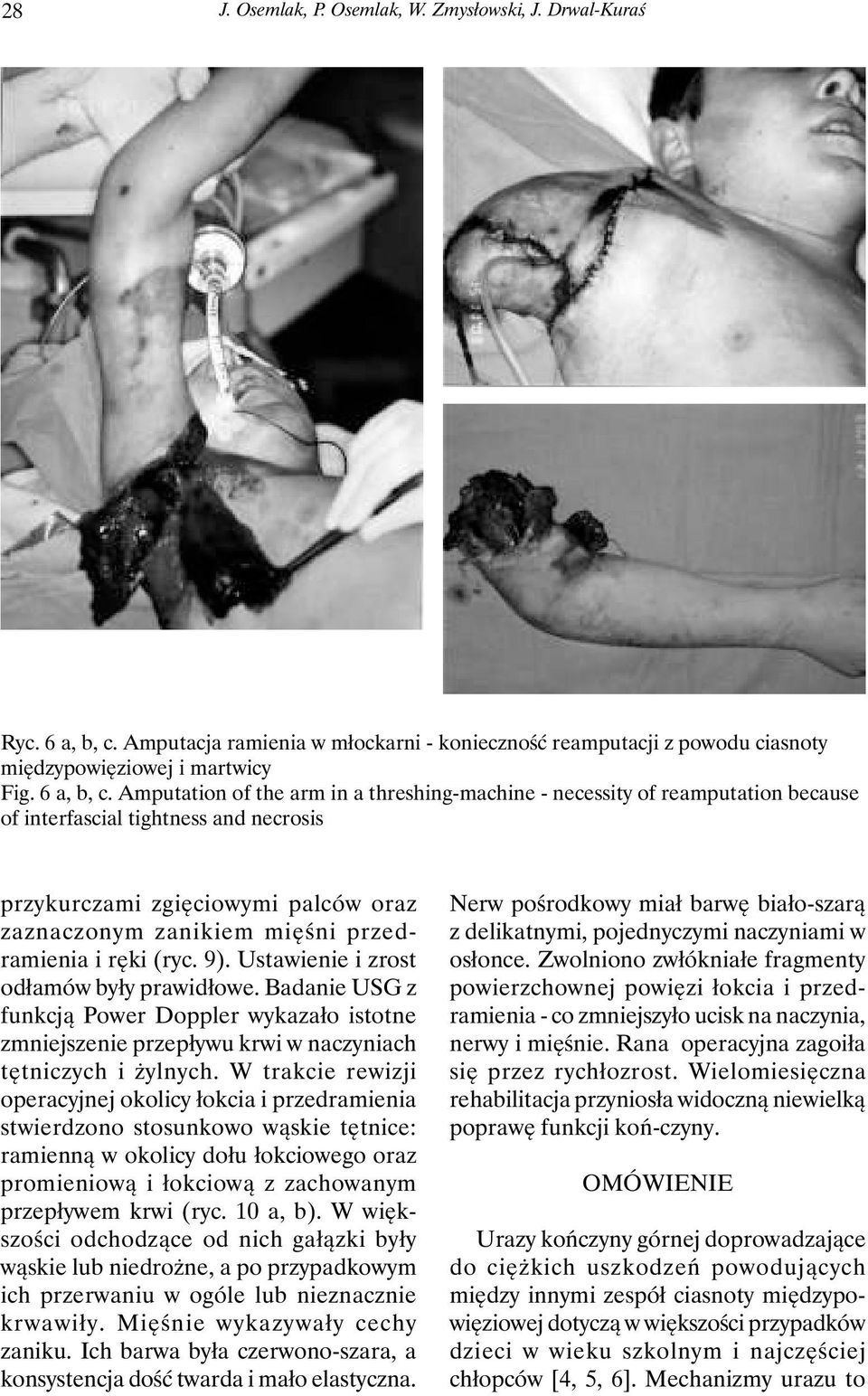 Amputation of the arm in a threshing-machine - necessity of reamputation because of interfascial tightness and necrosis przykurczami zgięciowymi palców oraz zaznaczonym zanikiem mięśni przedramienia