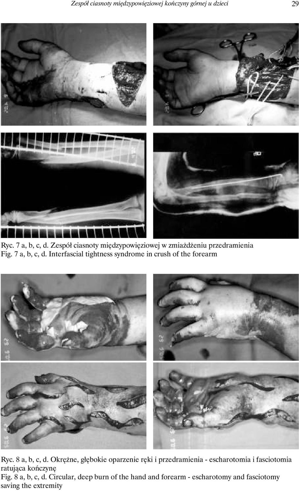 Interfascial tightness syndrome in crush of the forearm Ryc. 8 a, b, c, d.