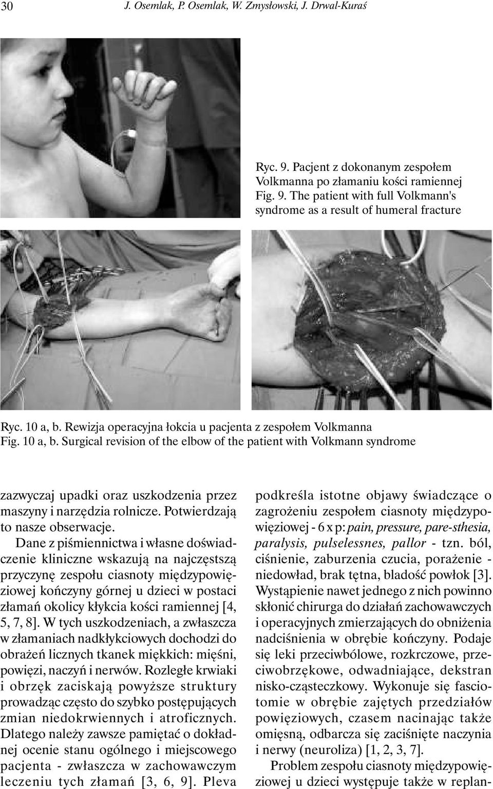 Surgical revision of the elbow of the patient with Volkmann syndrome zazwyczaj upadki oraz uszkodzenia przez maszyny i narzędzia rolnicze. Potwierdzają to nasze obserwacje.