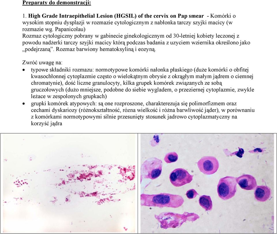 Papanicolau) Rozmaz cytologiczny pobrany w gabinecie ginekologicznym od 30-letniej kobiety leczonej z powodu nadżerki tarczy szyjki macicy którą podczas badania z uzyciem wziernika określono jako