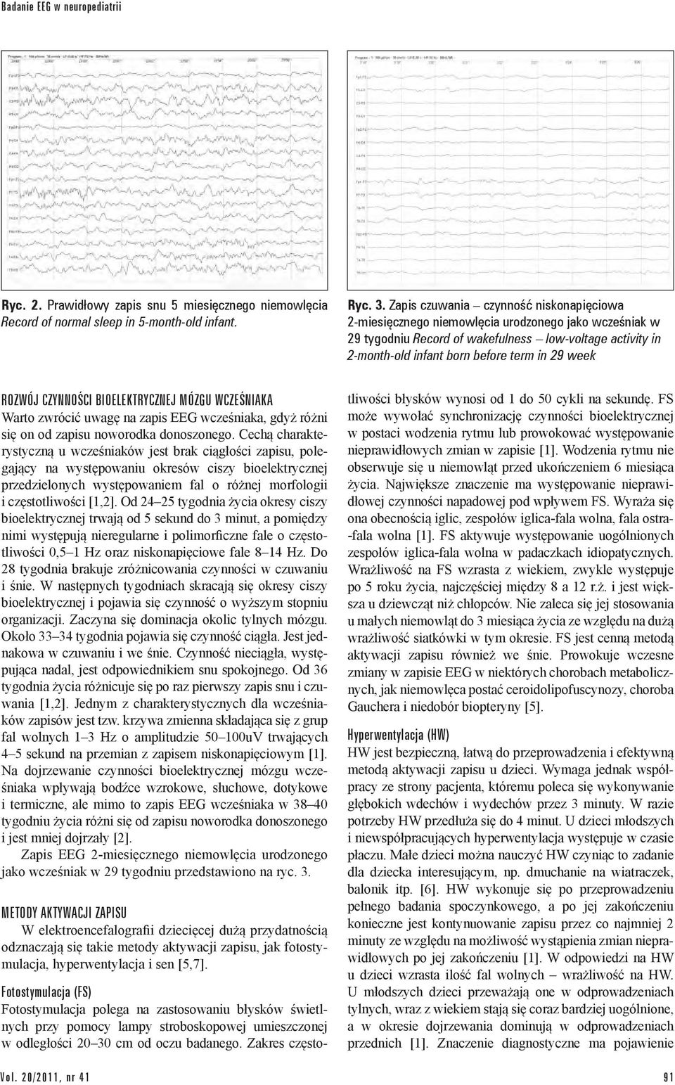 ROZWÓJ CZYNNOŚCI BIOELEKTRYCZNEJ MÓZGU WCZEŚNIAKA Warto zwrócić uwagę na zapis EEG wcześniaka, gdyż różni się on od zapisu noworodka donoszonego.