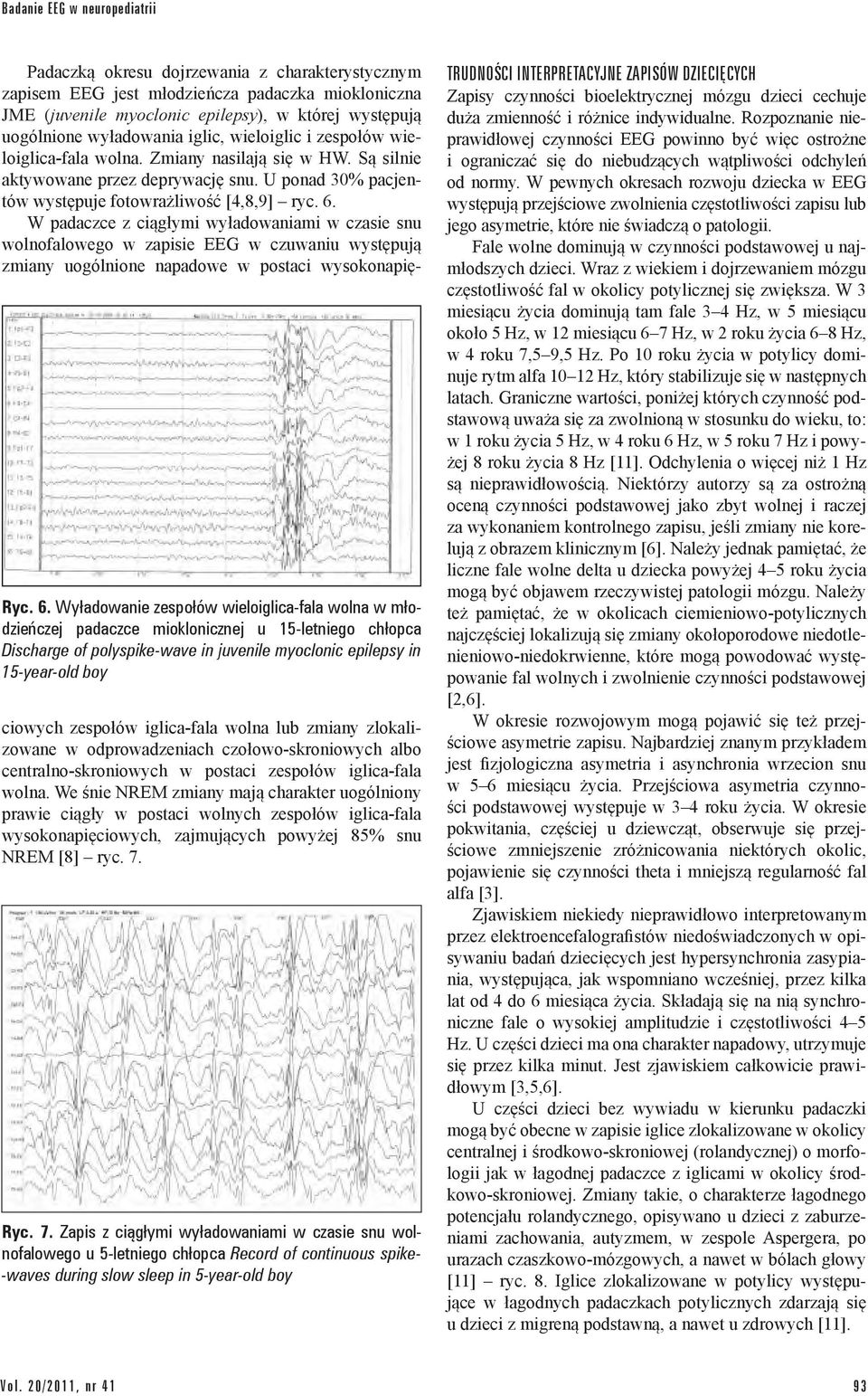 W padaczce z ciągłymi wyładowaniami w czasie snu wolnofalowego w zapisie EEG w czuwaniu występują zmiany uogólnione napadowe w postaci wysokonapię- Ryc. 6.