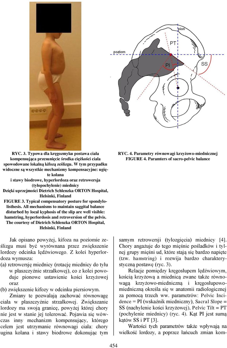Hospital, Helsinki, Finland FIGURE 3. Typical compensatory posture for spondylolisthesis.