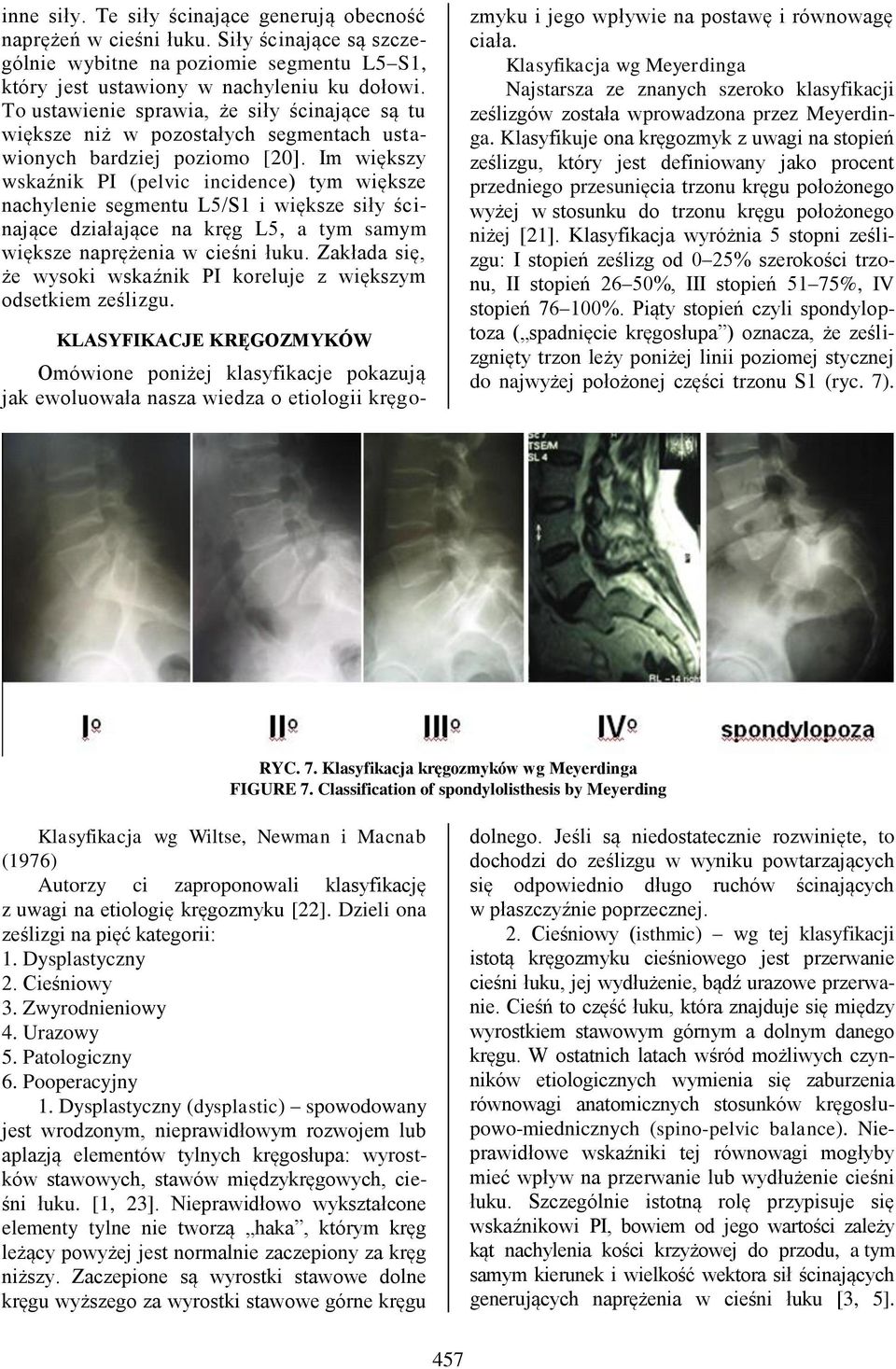 Im większy wskaźnik PI (pelvic incidence) tym większe nachylenie segmentu L5/S1 i większe siły ścinające działające na kręg L5, a tym samym większe naprężenia w cieśni łuku.