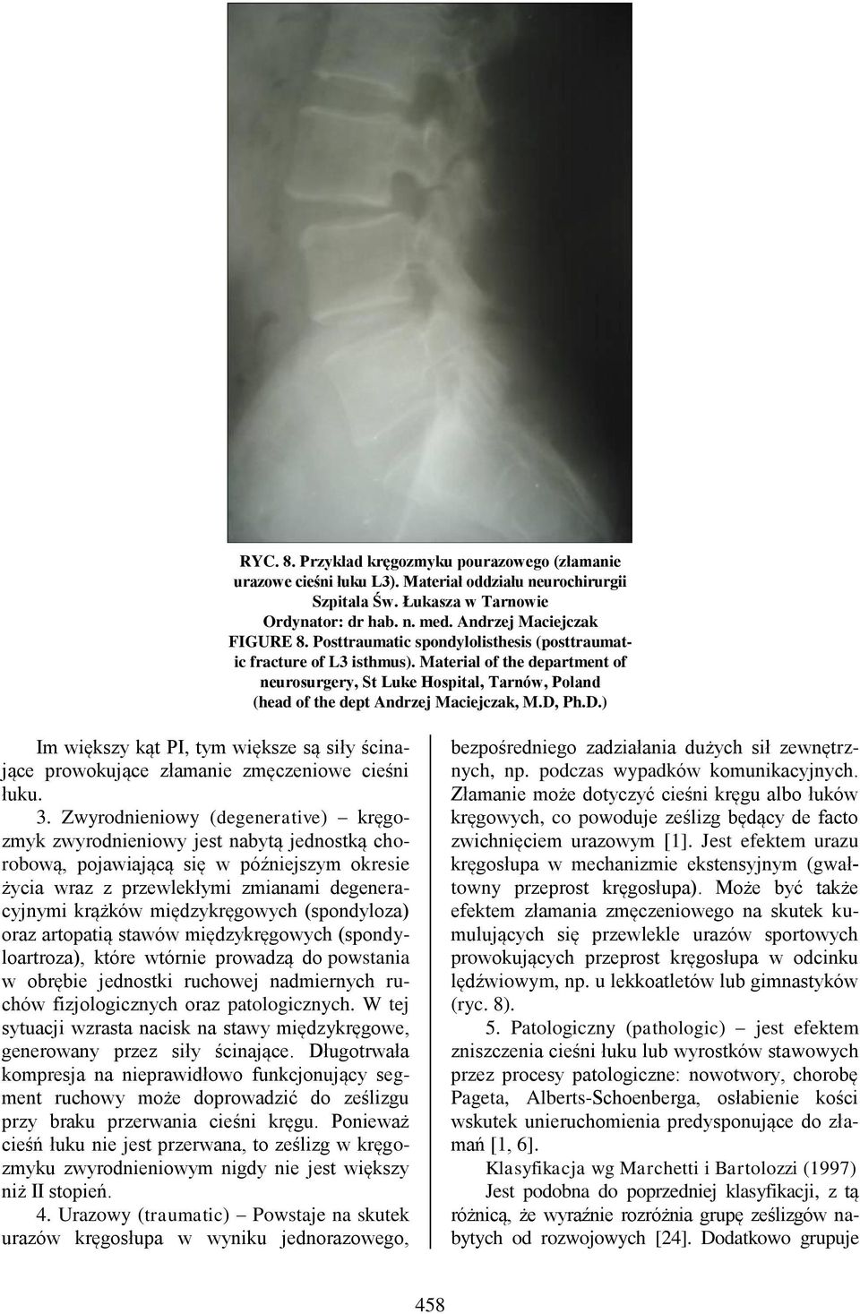 Ph.D.) Im większy kąt PI, tym większe są siły ścinające prowokujące złamanie zmęczeniowe cieśni łuku. 3.