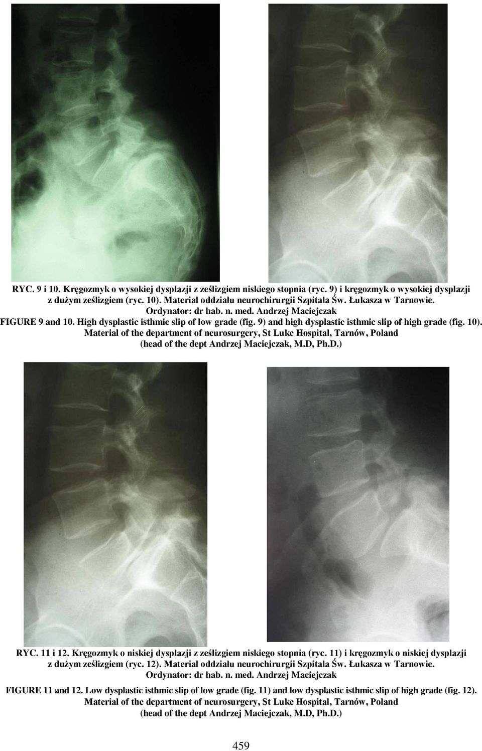 Material of the department of neurosurgery, St Luke Hospital, Tarnów, Poland (head of the dept Andrzej Maciejczak, M.D, Ph.D.) RYC. 11 i 12.