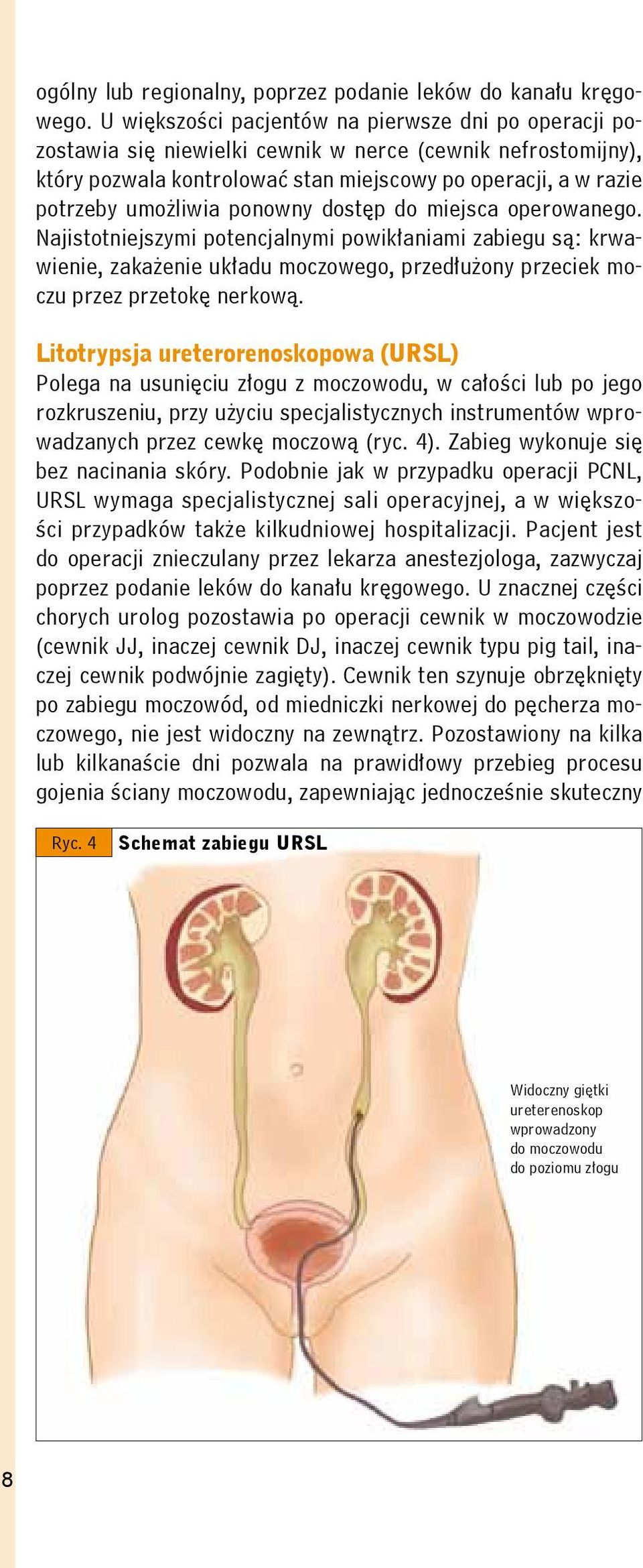 ponowny dostęp do miejsca operowanego. Najistotniejszymi potencjalnymi powikłaniami zabiegu są: krwawienie, zakażenie układu moczowego, przedłużony przeciek moczu przez przetokę nerkową.